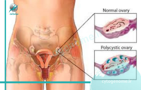 سندرم تخمدان پلی کیستیک (PCOS)