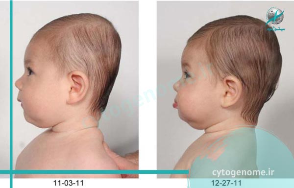 سندروم پلاژیوسفالی یا بدشکلی سر در نوزادان (سر صاف در نوزادان)
