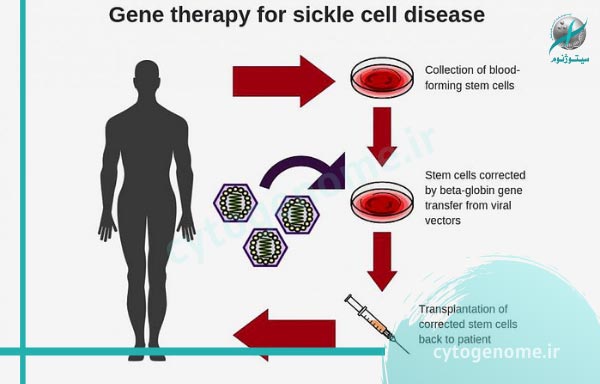 ژن درمانی در آنمی سلول داسی شکل