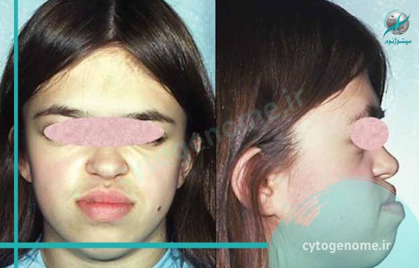 مشاوره ژنتیک در اختلالات دهان، سر و صورت
