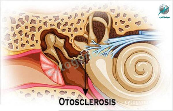 بیماری اتواسکلروزیس چیست؟